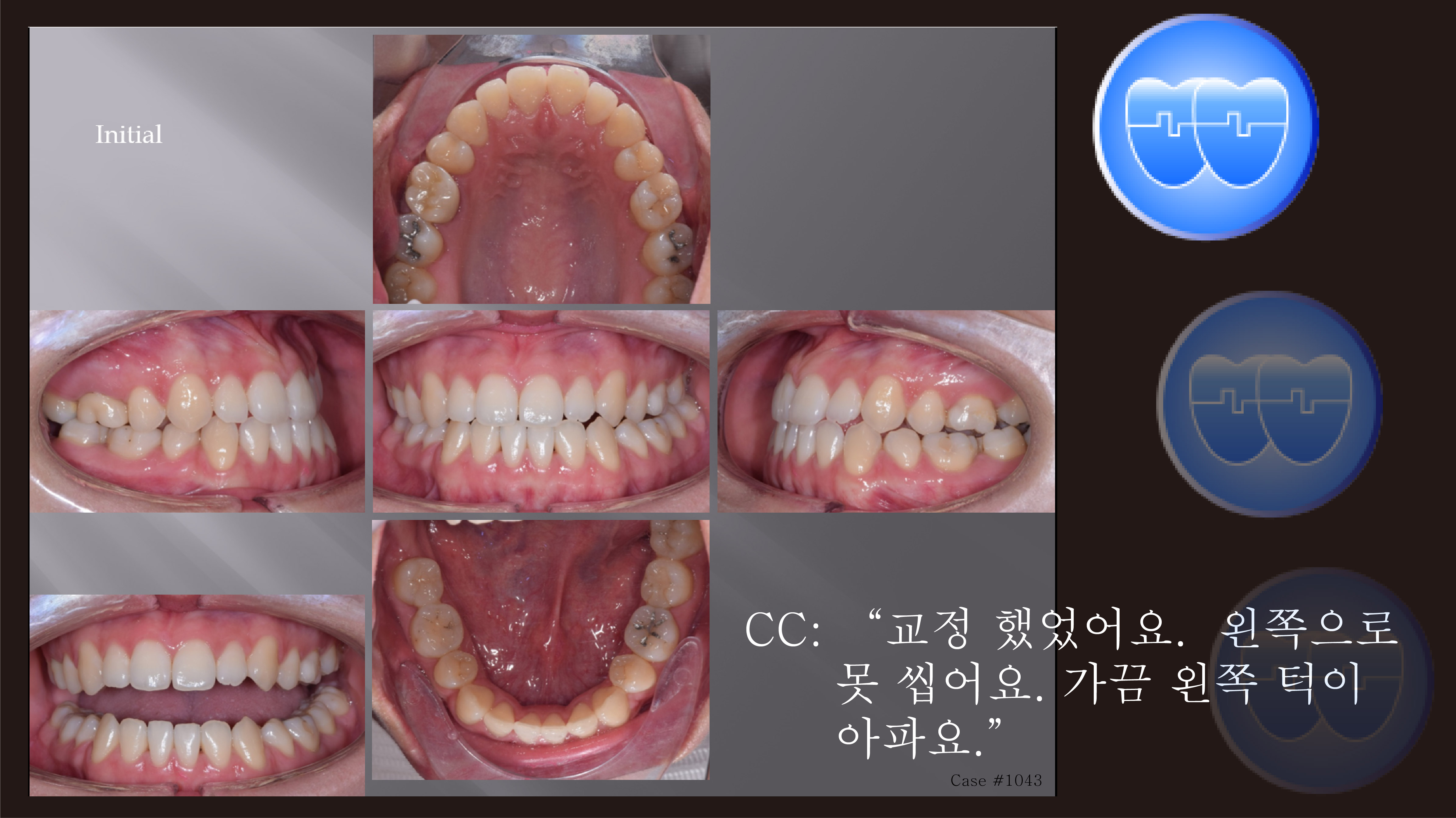 교정 Case 1043.  재교정, Functional Shift, Tilted Occlusal Table, #37 빠져 재식립, Sem #19