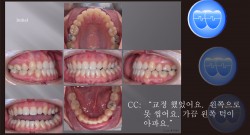 교정 Case 1043.  재교정, Functional Shift, Tilted Occlusal Table, #37 빠져 재식립, Sem #19