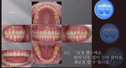 교정 Case 1024.  재교정, Retraction된 profile을 고치기 위해서, Sem #10