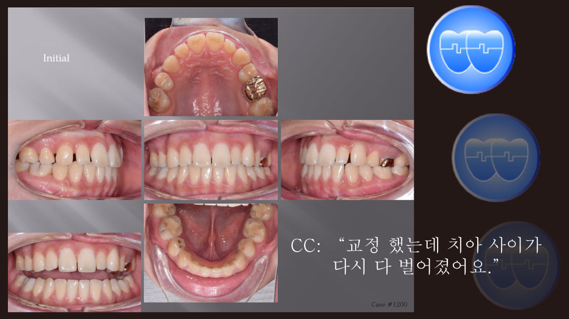 교정 Case 1200.  재교정, Prosth-Ortho., Sem #20.5