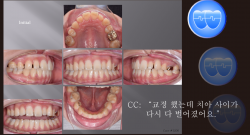 교정 Case 1200.  재교정, Prosth-Ortho., Sem #20.5