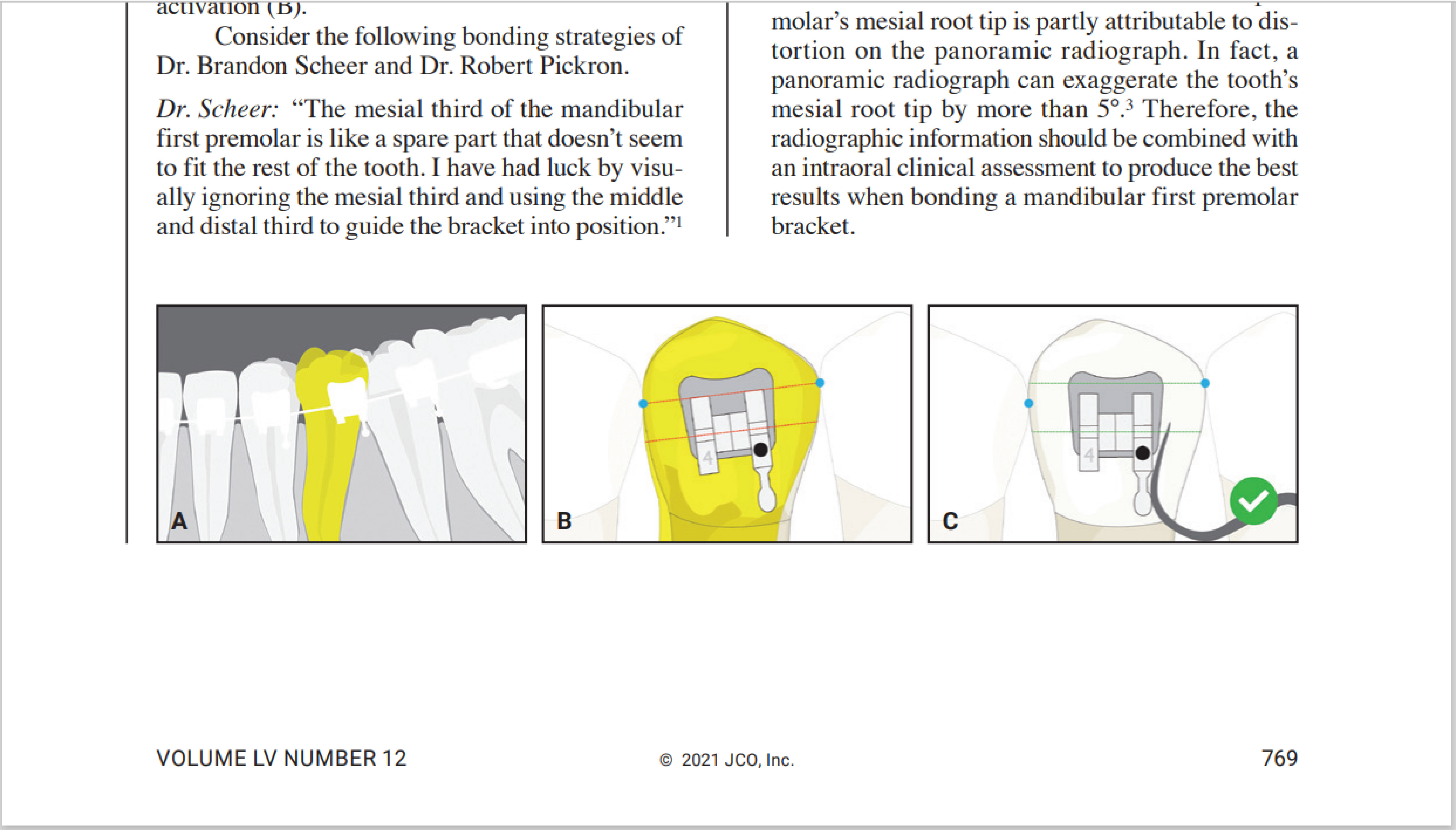 Preventing Unwanted Mesial Root Tip on Mandibular First Premolars