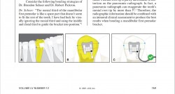 Preventing Unwanted Mesial Root Tip on Mandibular First Premolars