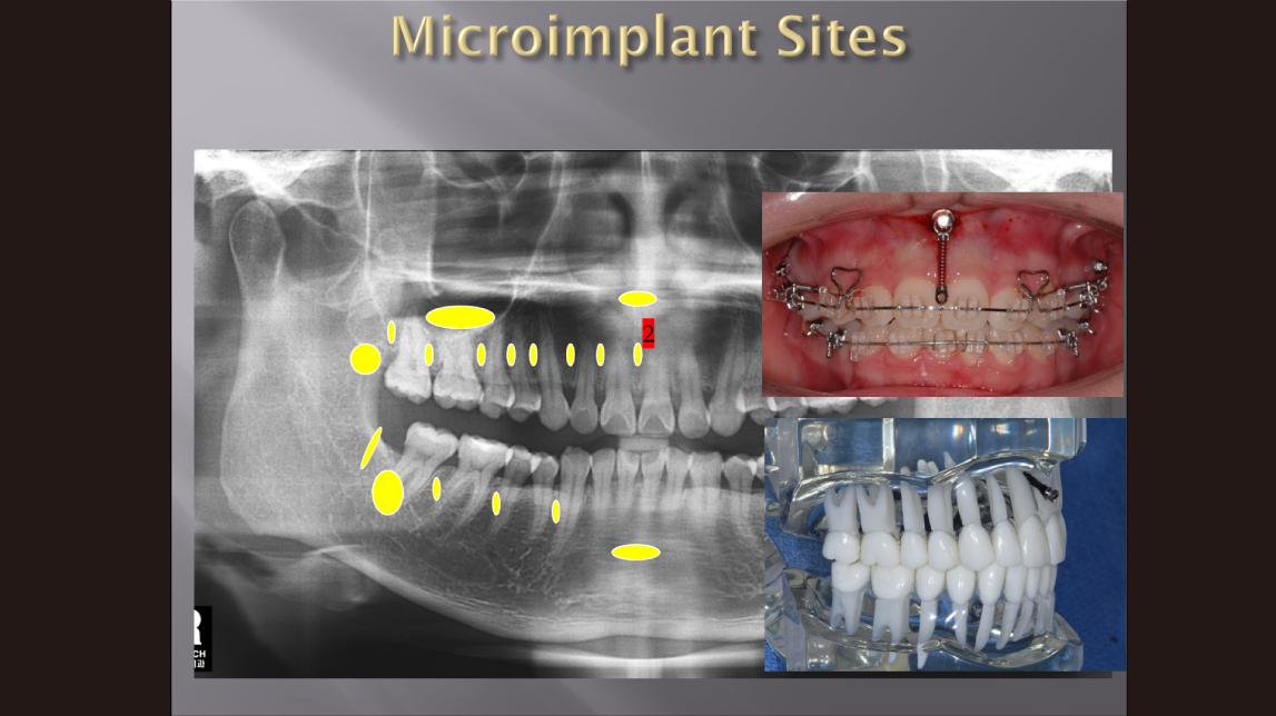 (실습 19) Microimplant Sites