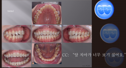 교정 Case 1286.  비발치, 성인교정, Dental Openbite, Sem #7