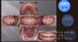 교정 Case 1168.  U4L5 발치, Posterior Scissor bite, Functional Shift, 비대칭 턱, Sem #19