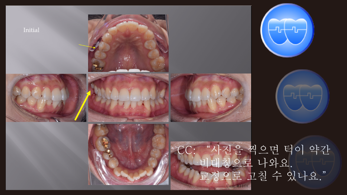 교정 Case 1168.  U4L5 발치, Posterior Scissor bite, Functional Shift, 비대칭 턱, Sem #19