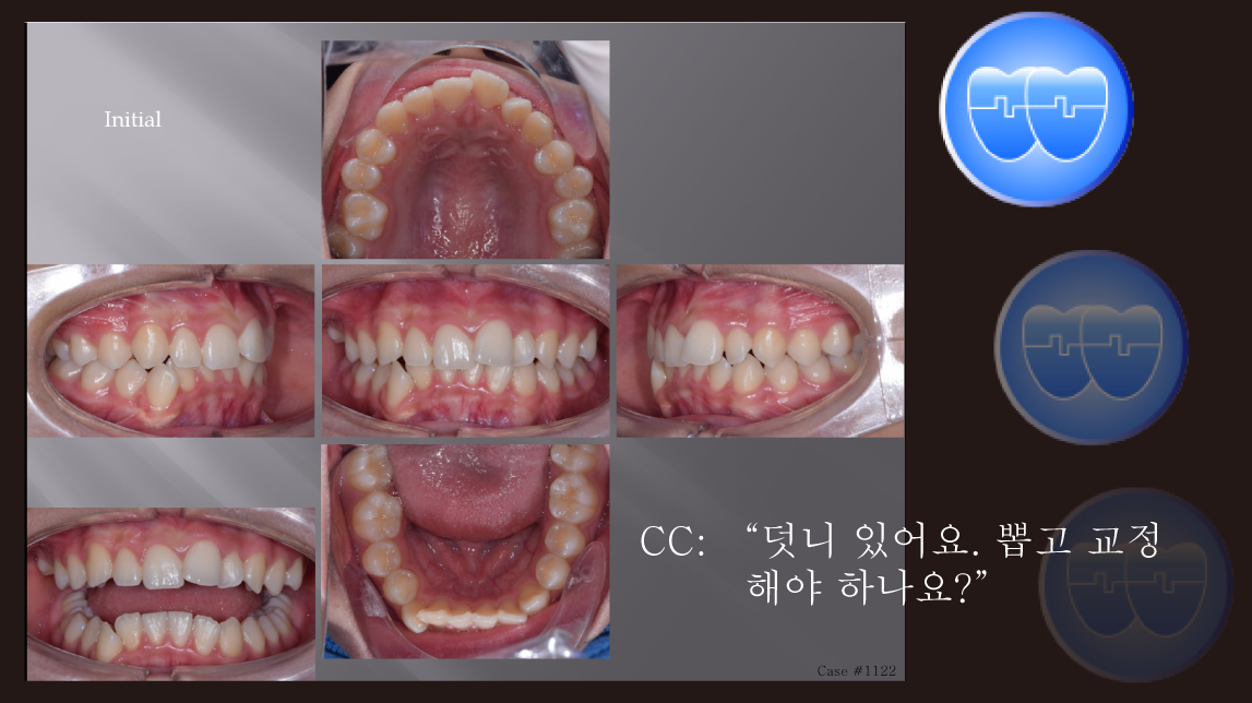 교정 Case 1122.  비발치, Moderate Lower Crowding, Dental Midline Problem, Sem #2