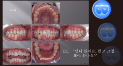 교정 Case 1122.  비발치, Moderate Lower Crowding, Dental Midline Problem, Sem #2