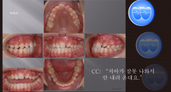 교정 Case 531.  비발치, Two Impacted Teeth #11 and #13, Sem #14