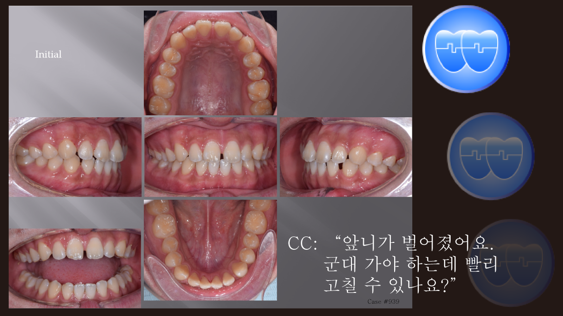 교정 Case 939.  비발치, Space Closure Problem, Strong Skeletal Resistance, Sem #5