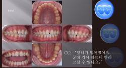 교정 Case 939.  비발치, Space Closure Problem, Strong Skeletal Resistance, Sem #5