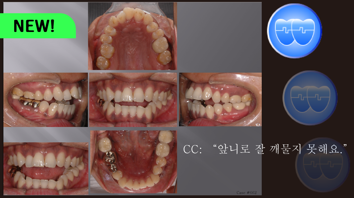 교정 Case 662.  비대칭 발치(15, 22, 36, 47번 발치), Sem #7