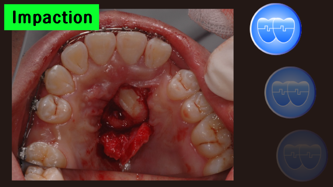 Impaction Course