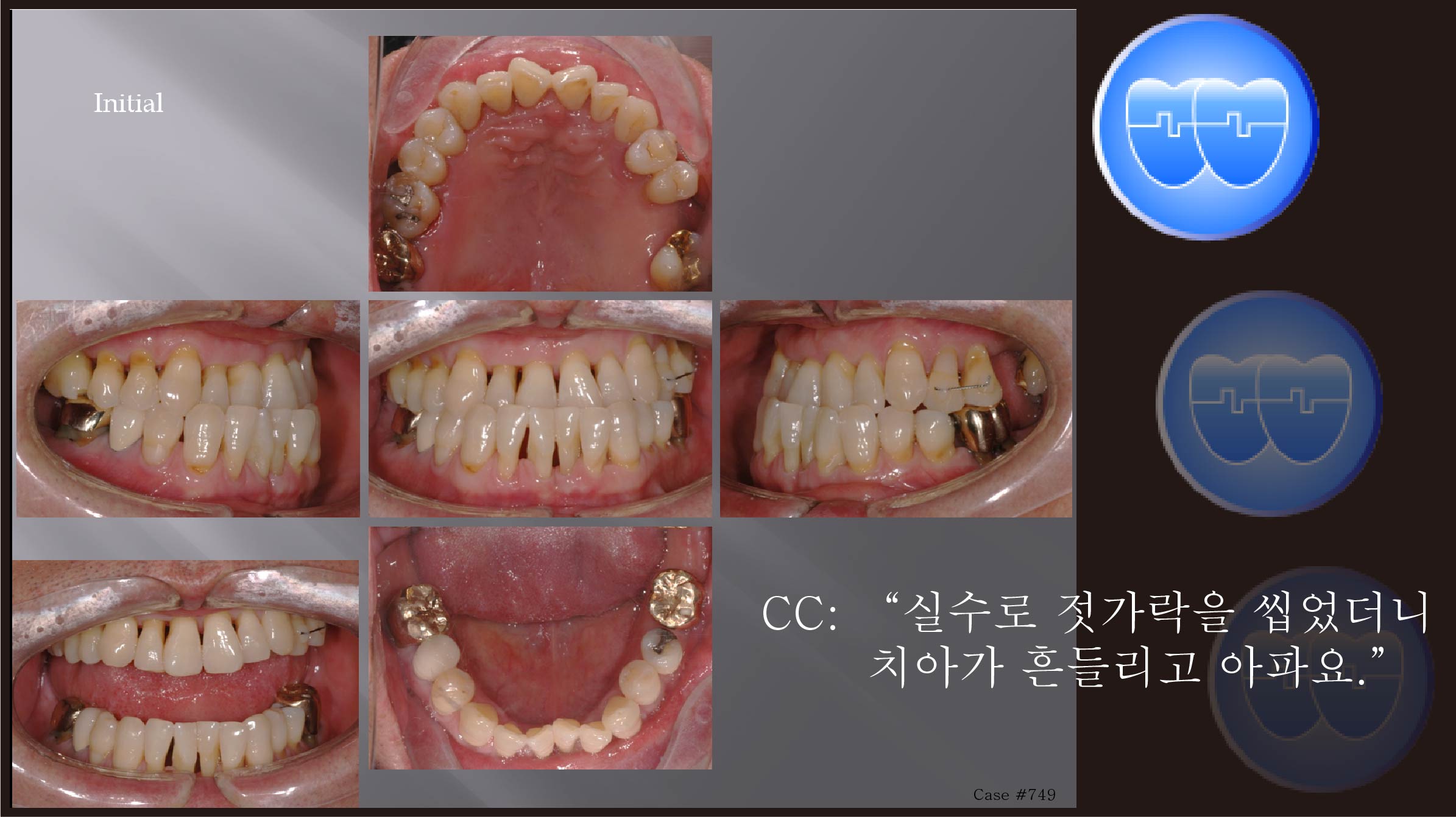 교정 Case 749.  비발치, 성인, Perio-Ortho, Prosth-Ortho., Class III, Sem #20