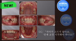 교정 Case 898.  비발치, Expansion, #37 Impaction, Sem #14