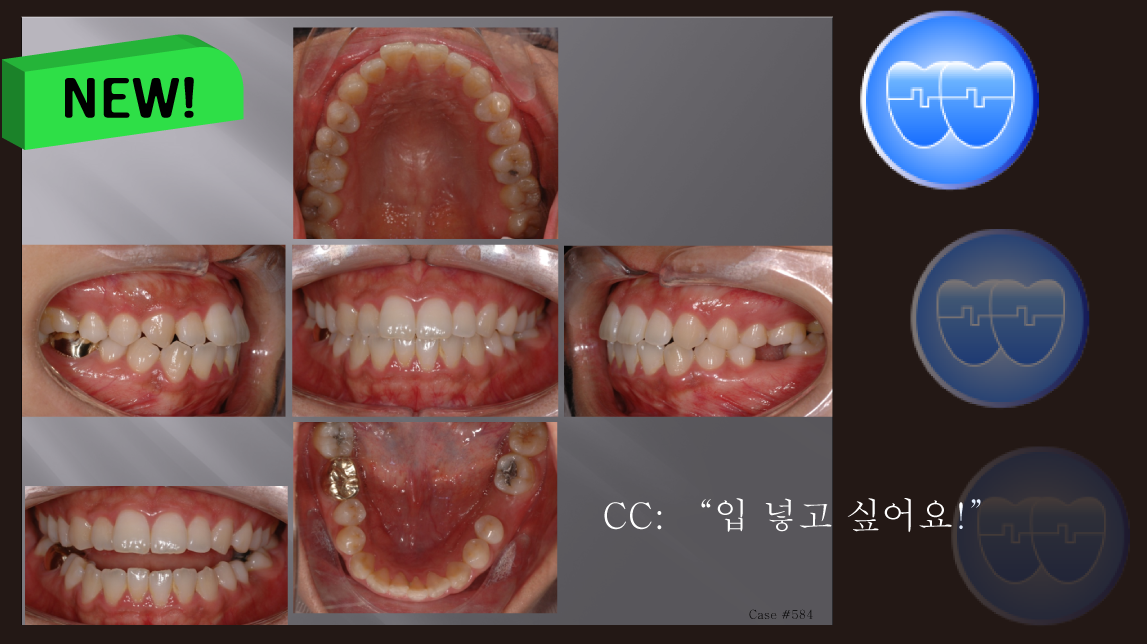 교정 Case 584.  비대칭 발치, Molar Substitution, Sem 13.2