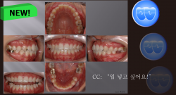 교정 Case 584.  비대칭 발치, Molar Substitution, Sem 13.2