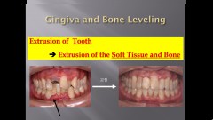 (강의 47) Seminar #20 Perio-Ortho 강의 (Part 2)