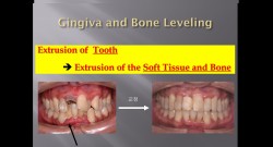 (강의 47) Seminar #20 Perio-Ortho 강의 (Part 2)