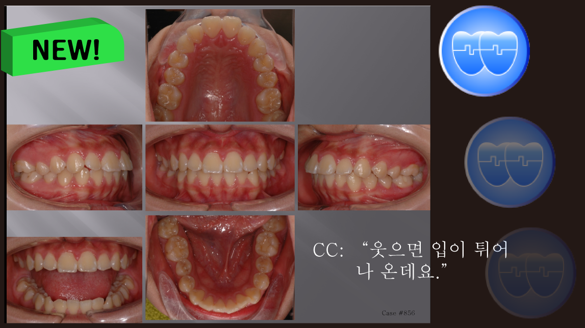 교정 Case 856.  U5L5 발치, Gummy Smile 가능성, 교정 도중에 TMJ 소리(Grinding), Sem #7.5