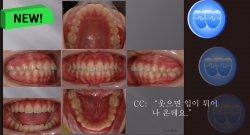 교정 Case 856.  U5L5 발치, Gummy Smile 가능성, 교정 도중에 TMJ 소리(Grinding), Sem #7.5