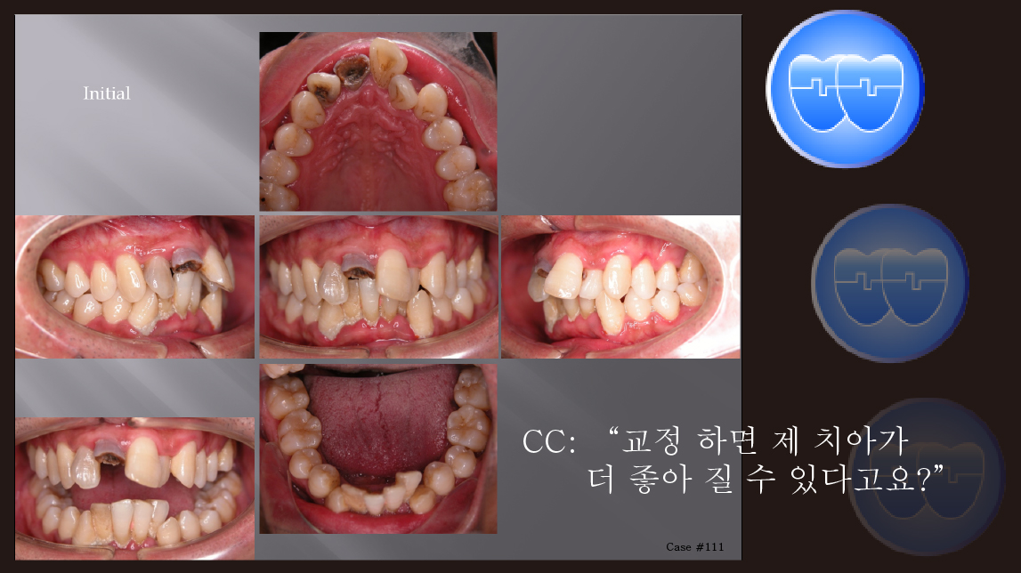 교정 case 111.  Perio-ortho, Lower arch crowding, Sem #20