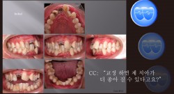 교정 case 111.  Perio-ortho, Lower arch crowding, Sem #20