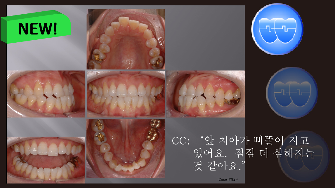 교정 Case 829.  One Lower Incisor 발치, Anterior Crossbite, Sem #13