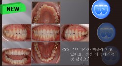 교정 Case 829.  One Lower Incisor 발치, Anterior Crossbite, Sem #13