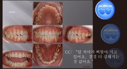 교정 Case 829.  One Lower Incisor 발치, Anterior Crossbite, Sem #13