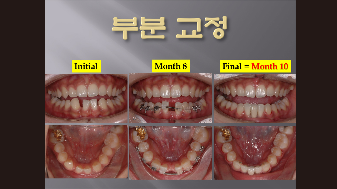 (강의 52) Sem #20.5 부분교정 강의 (Part 1)