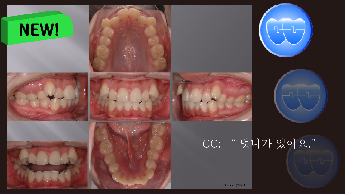 교정 Case 523. U5L4 발치, High Canine, Sem #12.3