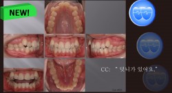 교정 Case 523. U5L4 발치, High Canine, Sem #12.3