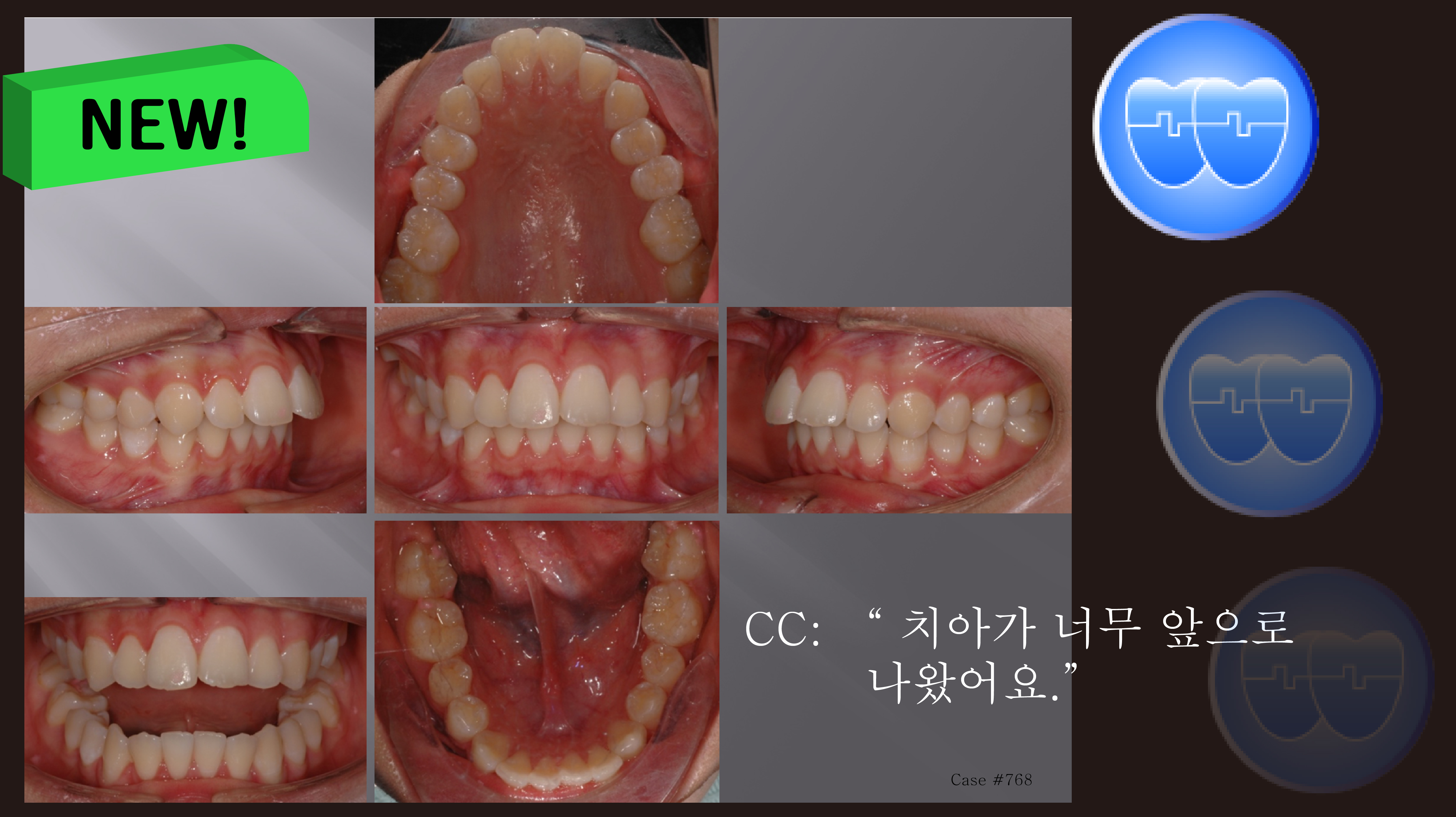 교정 Case 768. U5 발치, Severe Overjet, Vertical Grower, Sem 12.6