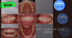 교정 Case 768. U5 발치, Severe Overjet, Vertical Grower, Sem 12.6