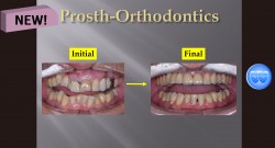 (강의 53) Sem #20.5 Prosth-Orthodontics 강의