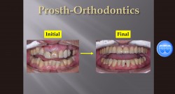 (강의 53) Sem #20.5 Prosth-Orthodontics 강의