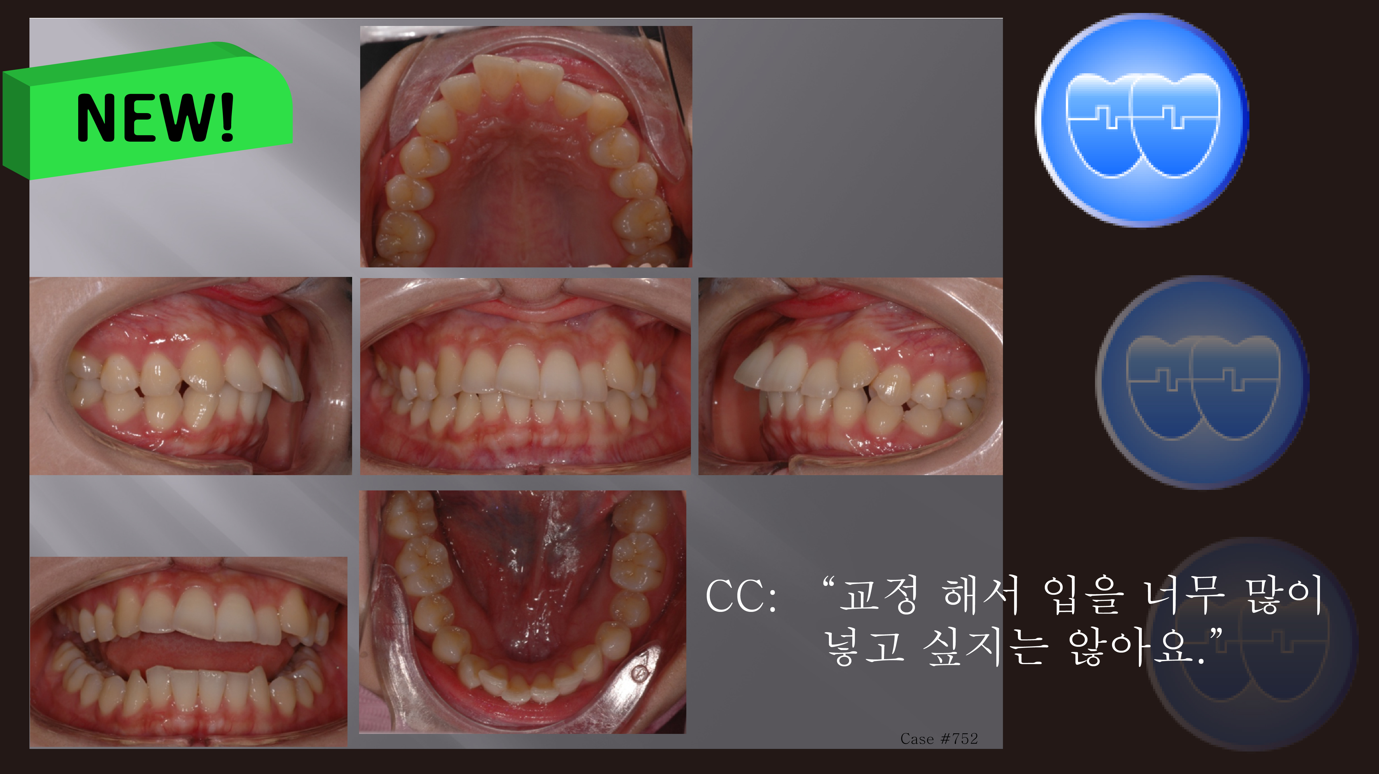 교정 Case 752.  U5 발치, Deepbite, Sem#6