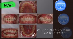 교정 Case 752.  U5 발치, Deepbite, Sem#6