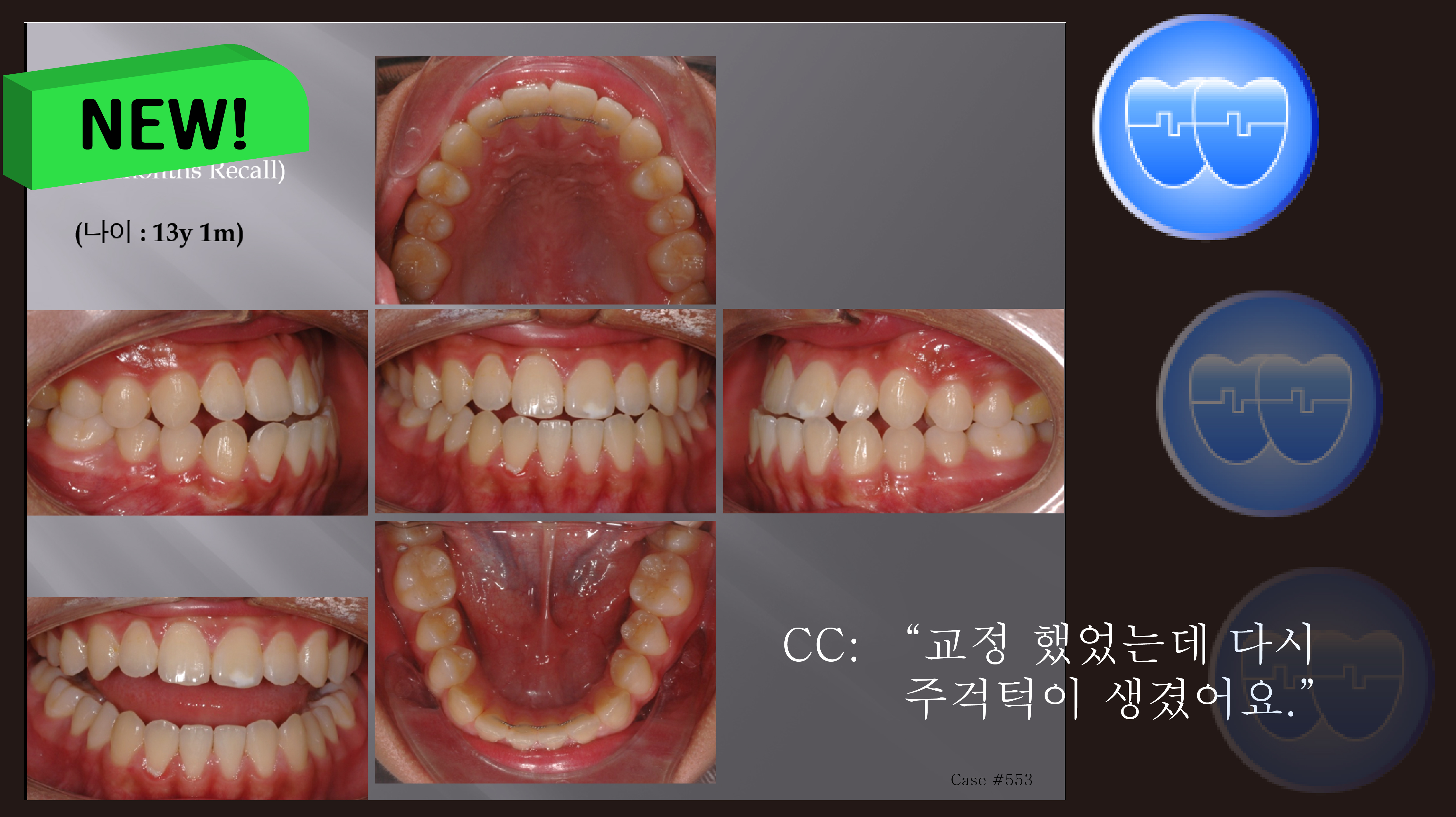 교정 Case 553.  Class III, 재교정, Relapse, 교정 Case 349(예전), Sem #6