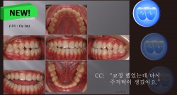 교정 Case 553.  Class III, 재교정, Relapse, 교정 Case 349(예전), Sem #6