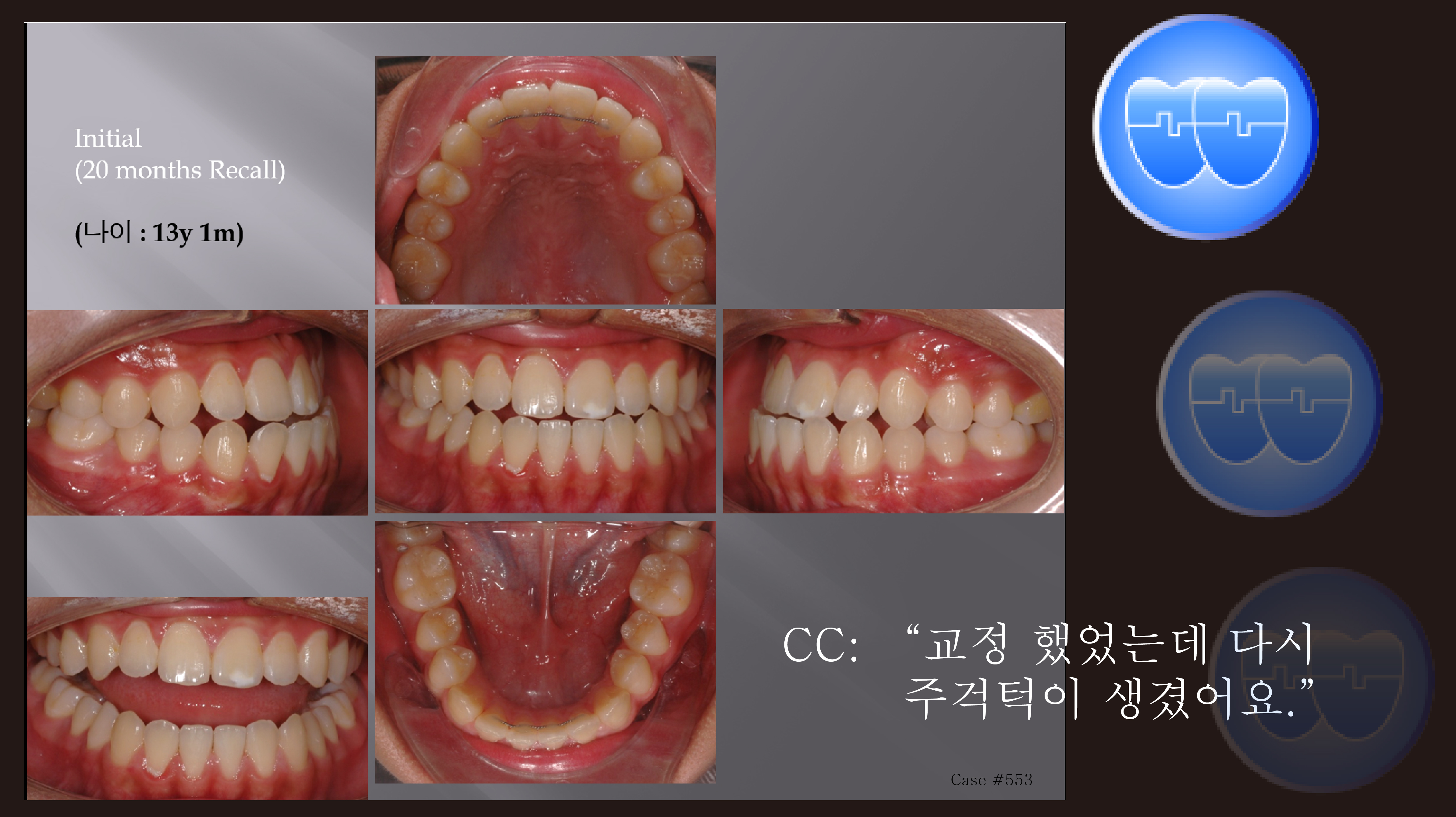 교정 Case 553. Class III, 재교정, Relapse, 교정 Case 349(예전), Sem #6(New,로고)