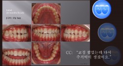 교정 Case 553. Class III, 재교정, Relapse, 교정 Case 349(예전), Sem #6(New,로고)