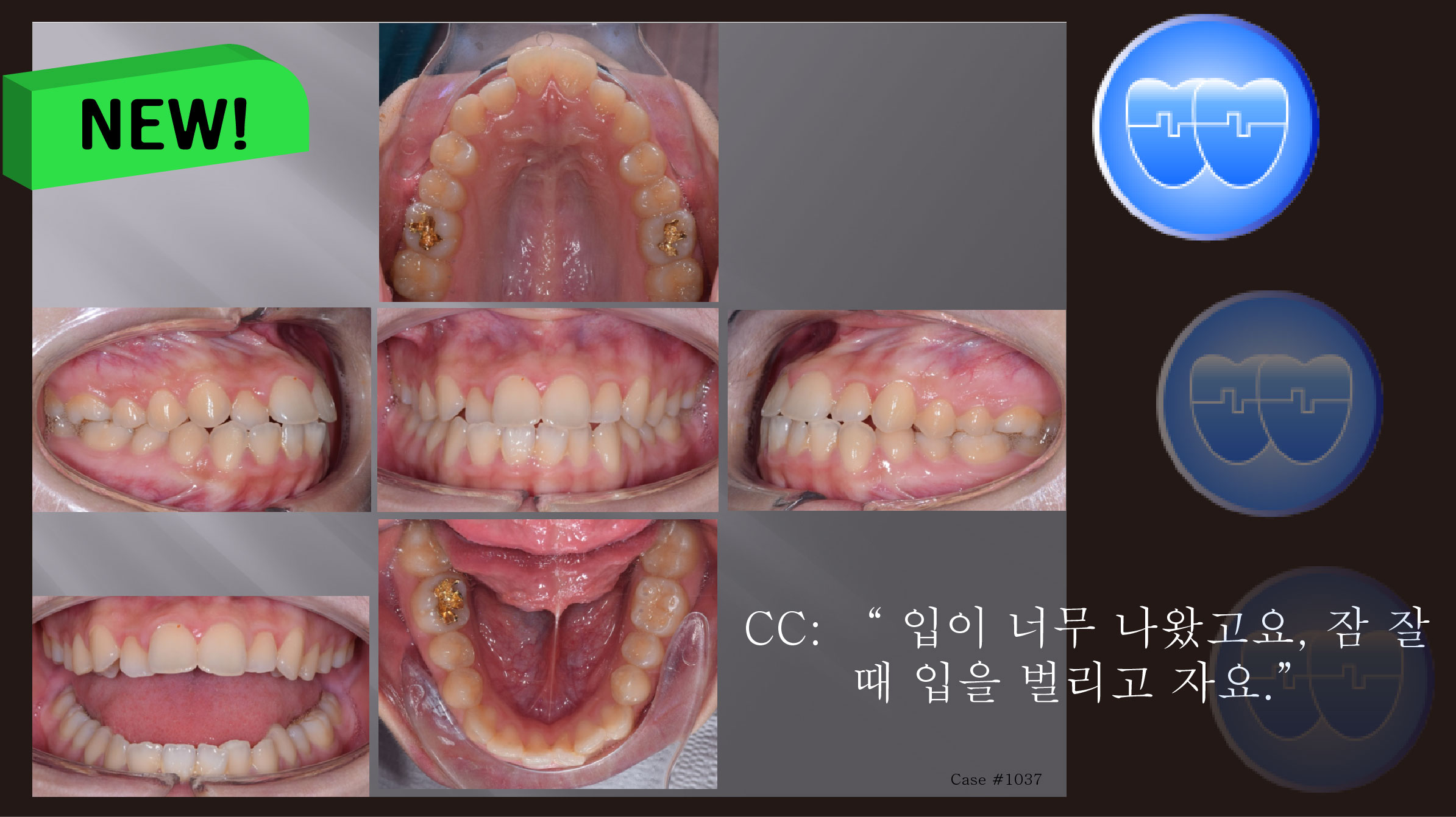 교정 Case 1037.  U5L4 발치, Protrusion, Sk. Resistance, LL Cortic., Tor. Compl., Sem #13.7