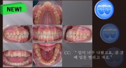 교정 Case 1037.  U5L4 발치, Protrusion, Sk. Resistance, LL Cortic., Tor. Compl., Sem #13.7