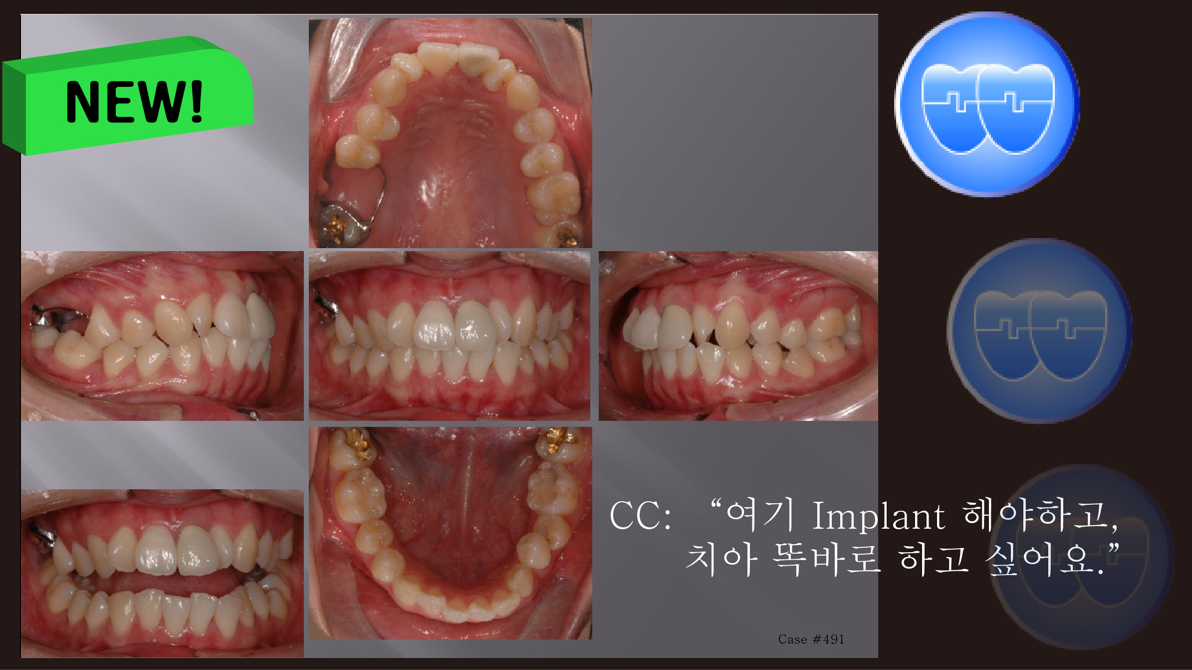 교정 Case 491. 비대칭 발치, Upper Molar Extraction, Low Sinus, Sem #13.2