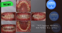 교정 Case 491. 비대칭 발치, Upper Molar Extraction, Low Sinus, Sem #13.2