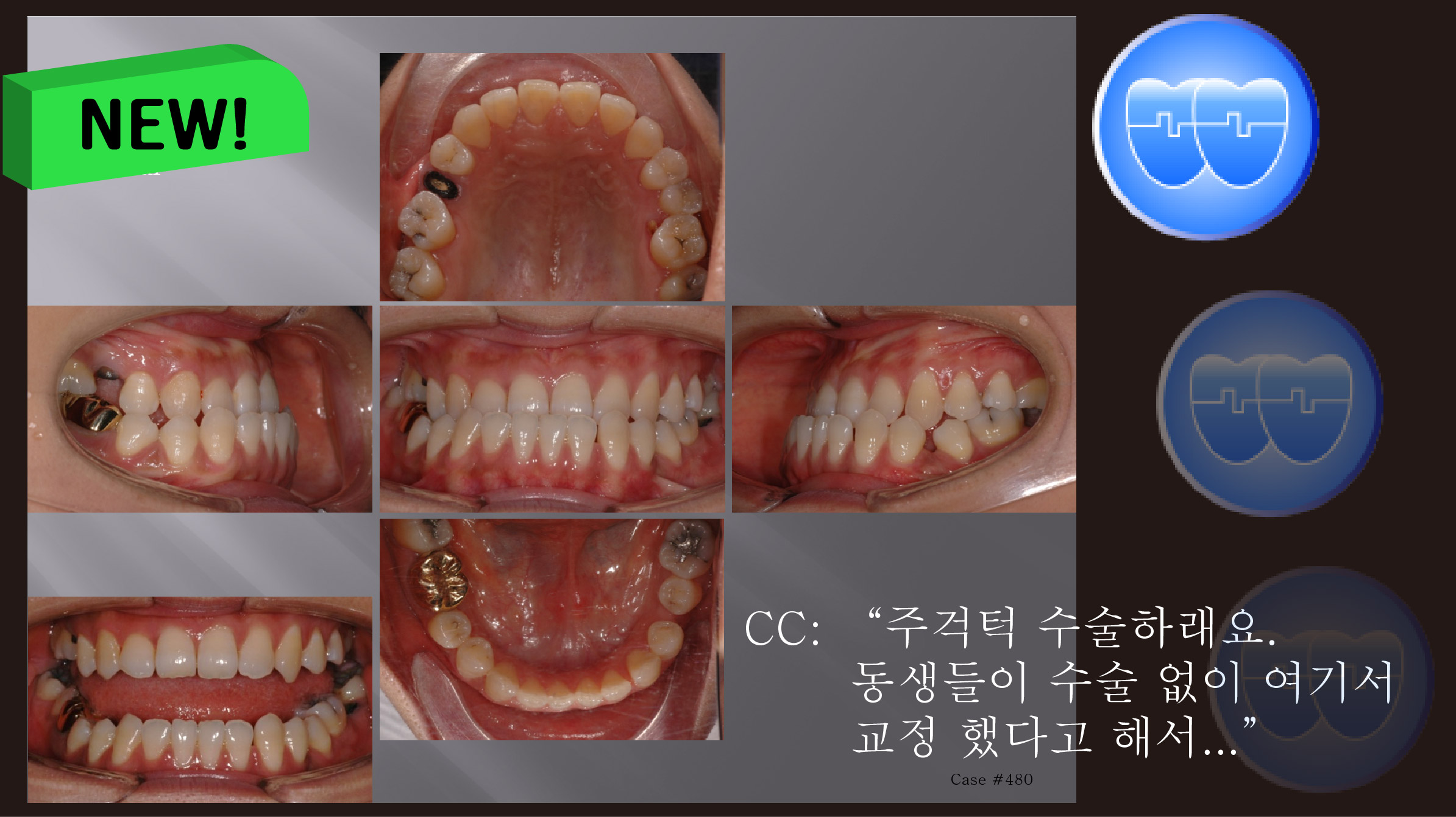 교정 Case 480.  비대칭 발치, Cl III, 심각한 주걱턱, LL Corticotomy, Popping Sound, TMJ, Sem 13.7