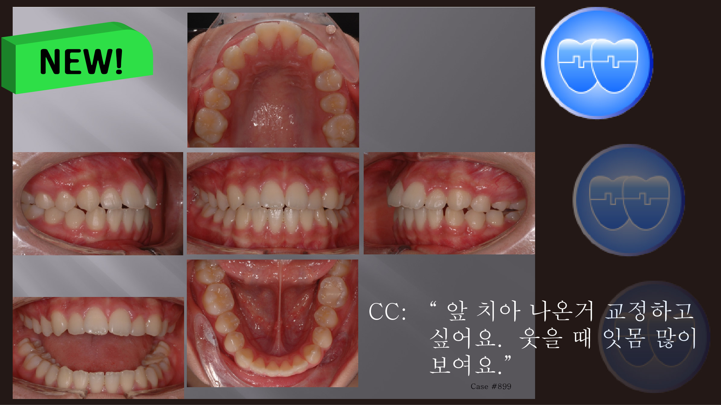 교정 Case 899.  U5 발치, Class II, Moderate Protrusion with Overjet, Sem #12.6